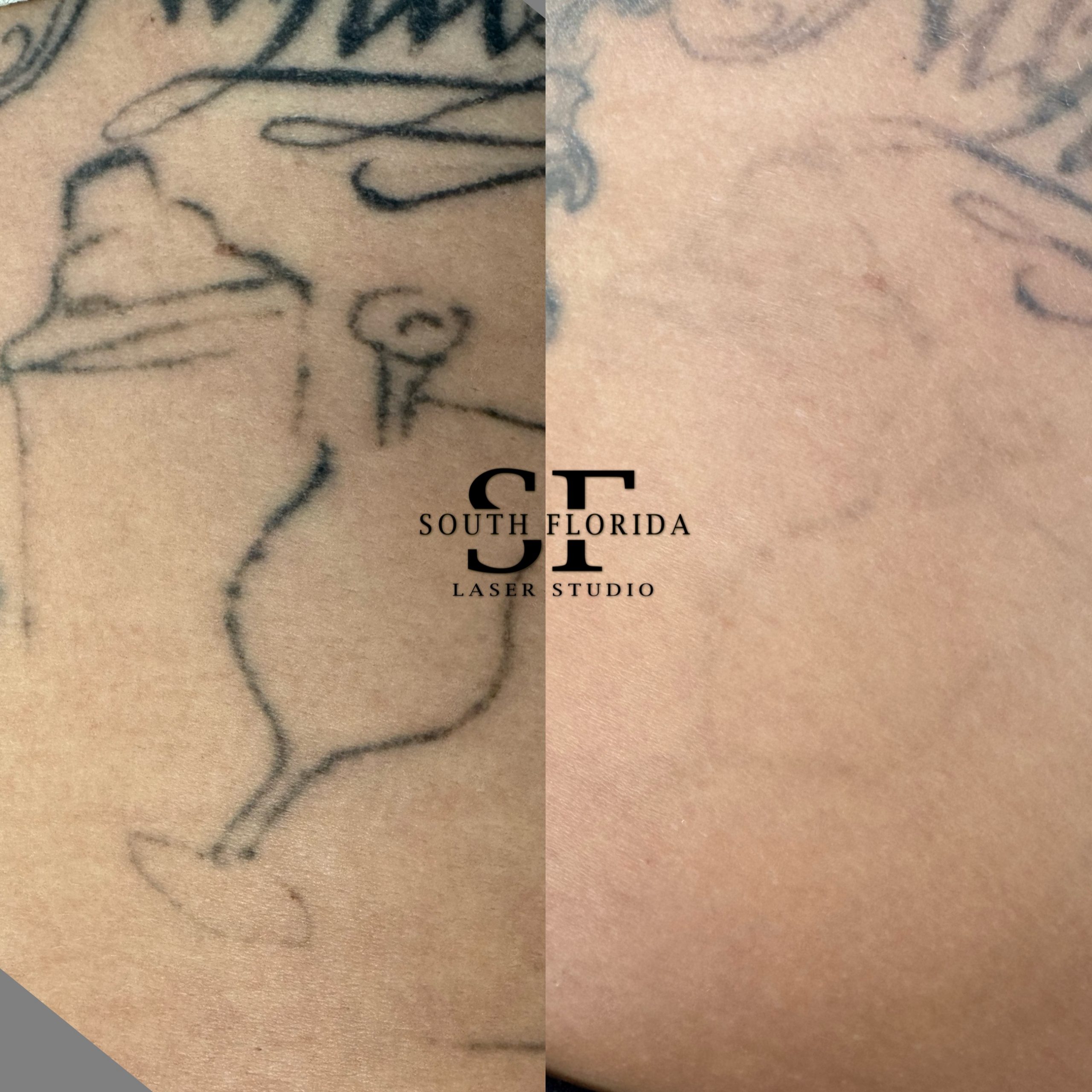 Fading a tattoo to prepare for a cover-up with PicoWay at South Florida Laser Studio
