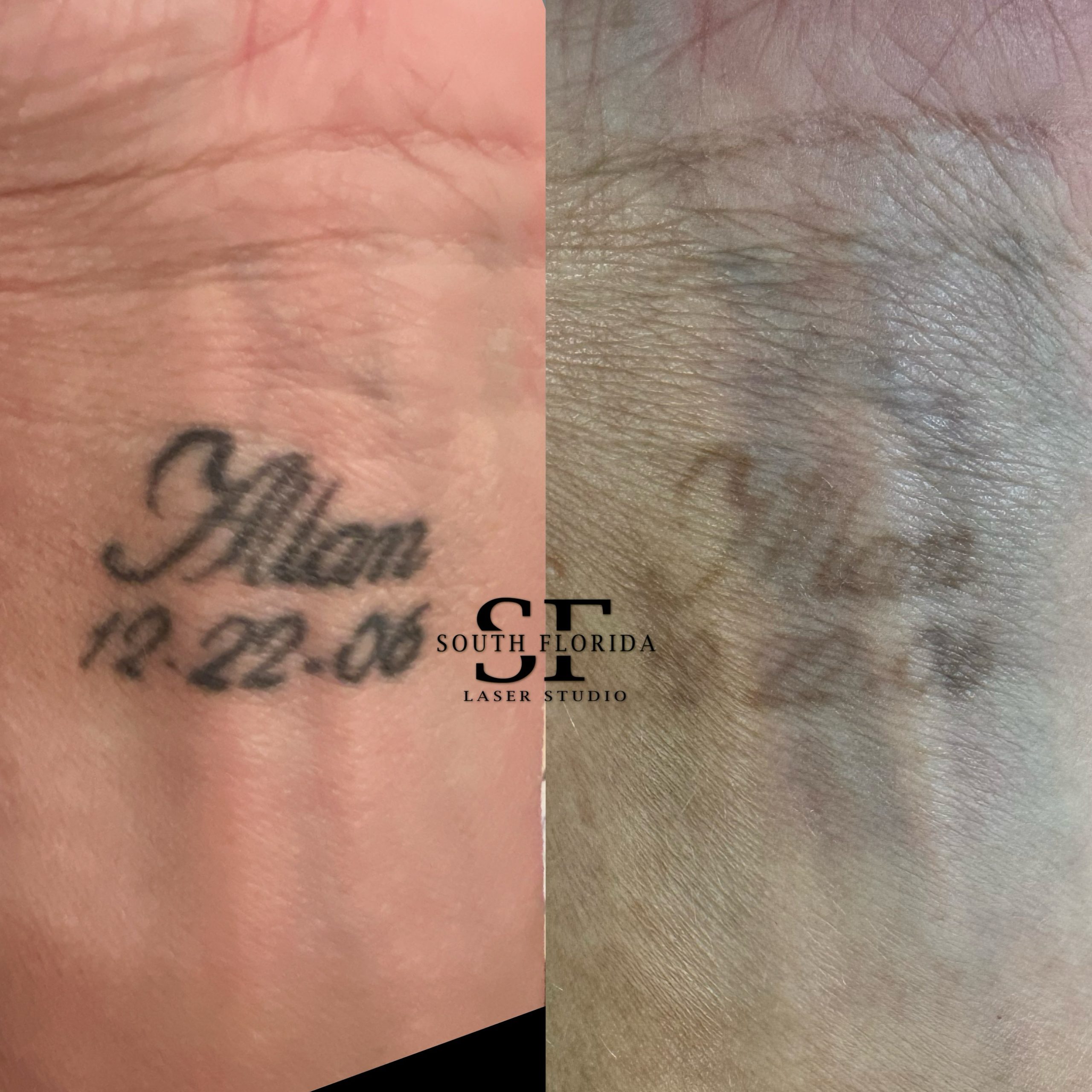 Laser tattoo removal treatment at South Florida Laser Studio in Boca Raton and Miami, FL