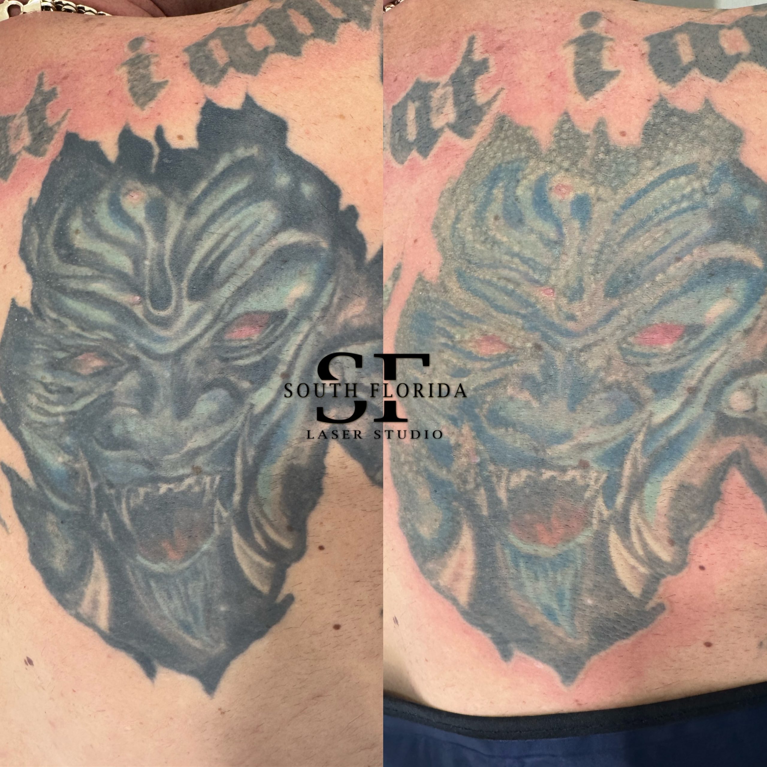 Tattoo removal in South Florida — before and after results at South Florida Laser Studio