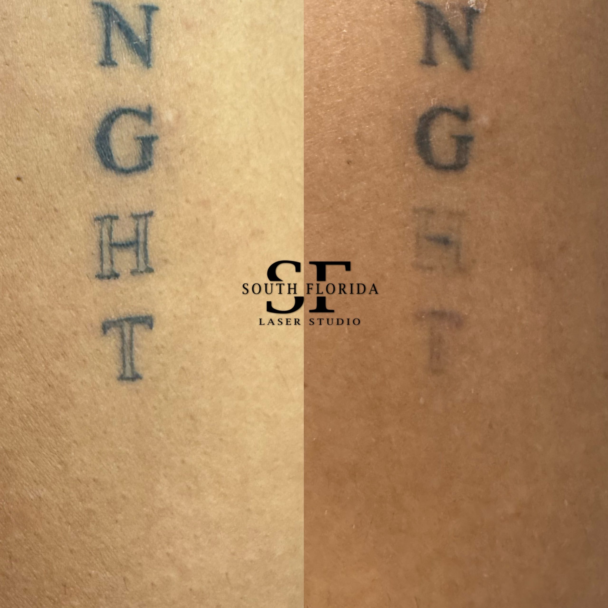 Tattoo fading and removal results for dark ink — South Florida Laser Studio