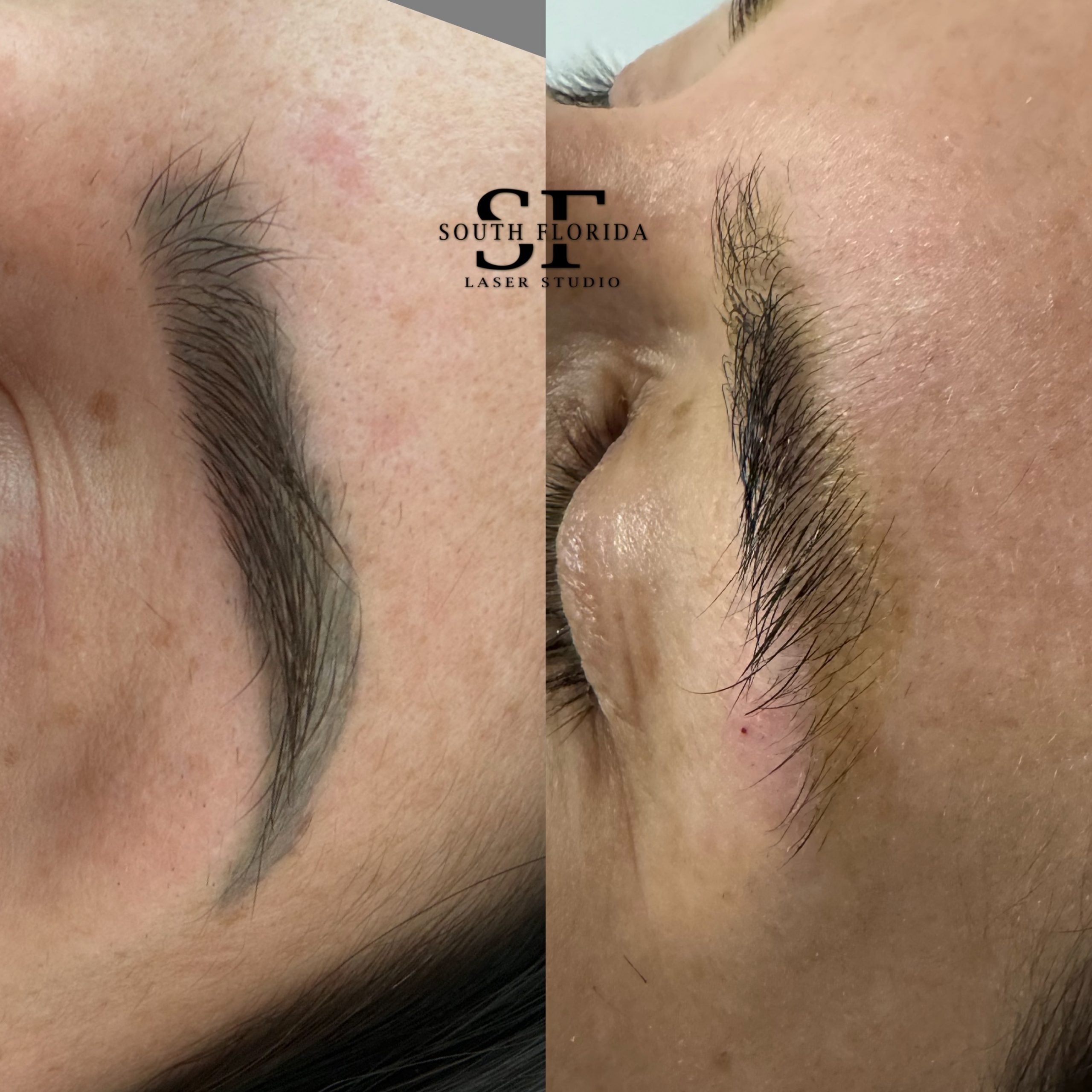 Laser tattoo removal near me — treatment results at South Florida Laser Studio, Boca Raton and Miami, FL