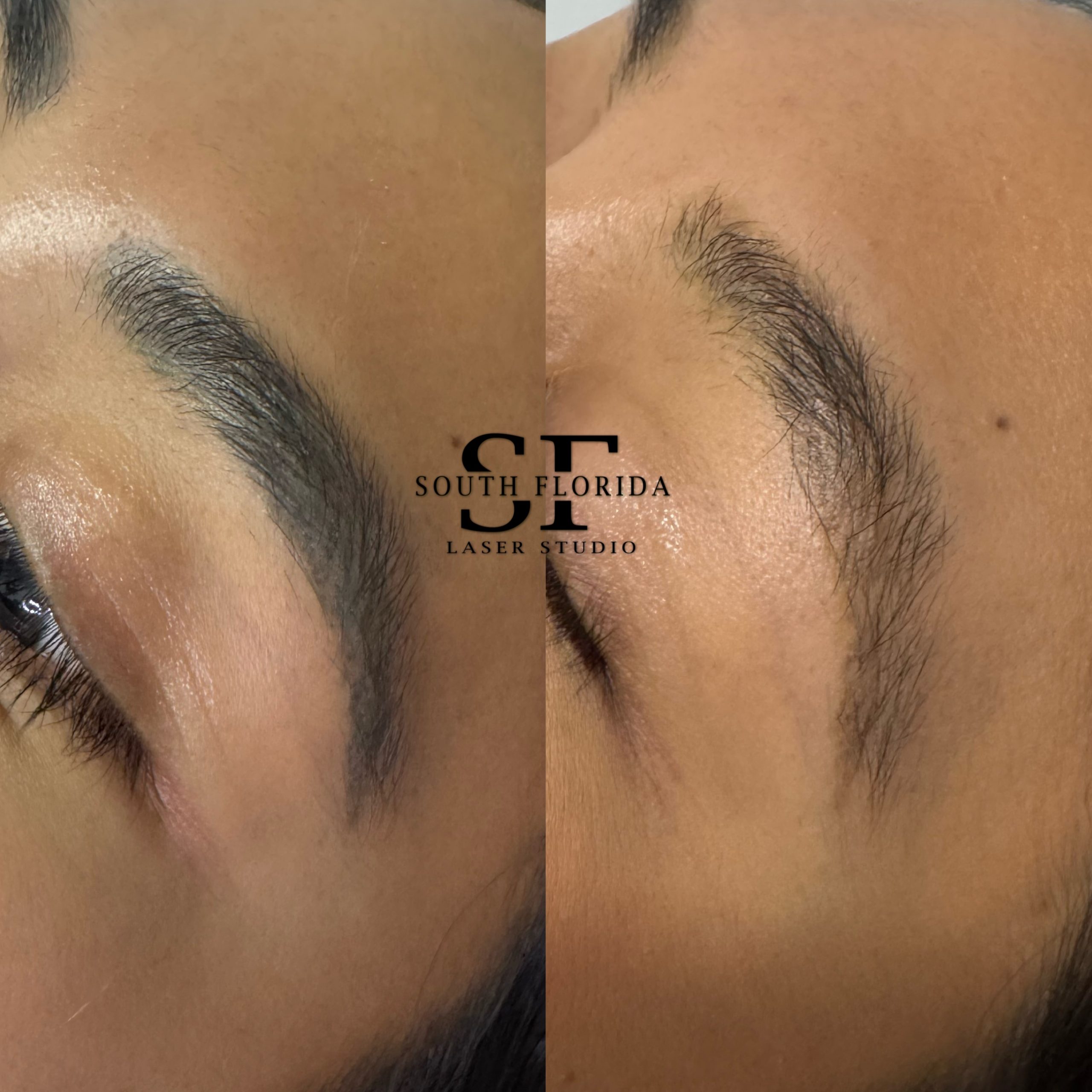 Laser removal progress on multicolor tattoo — South Florida Laser Studio