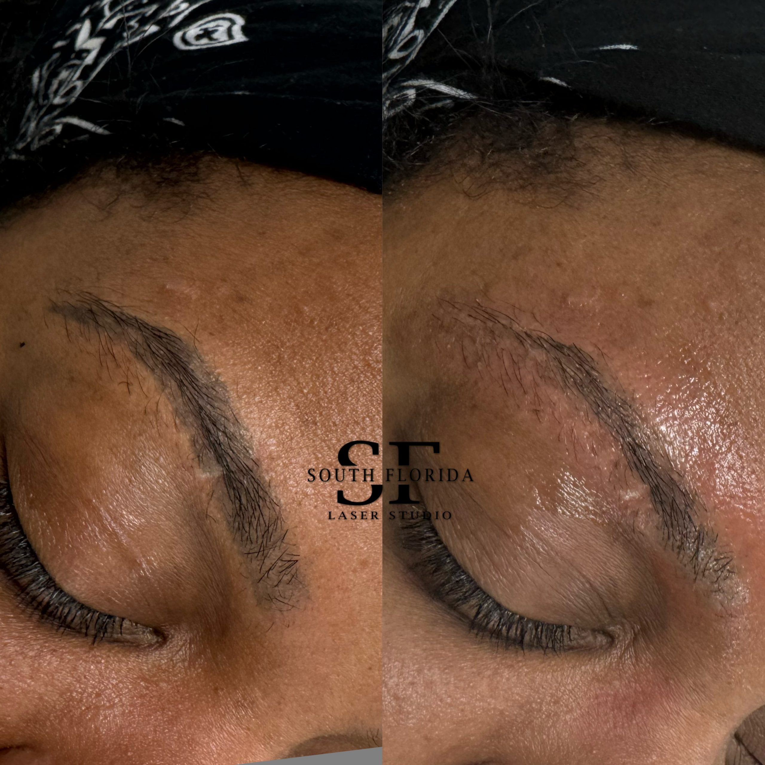 Professional laser tattoo removal before and after — South Florida Laser Studio Boca Raton