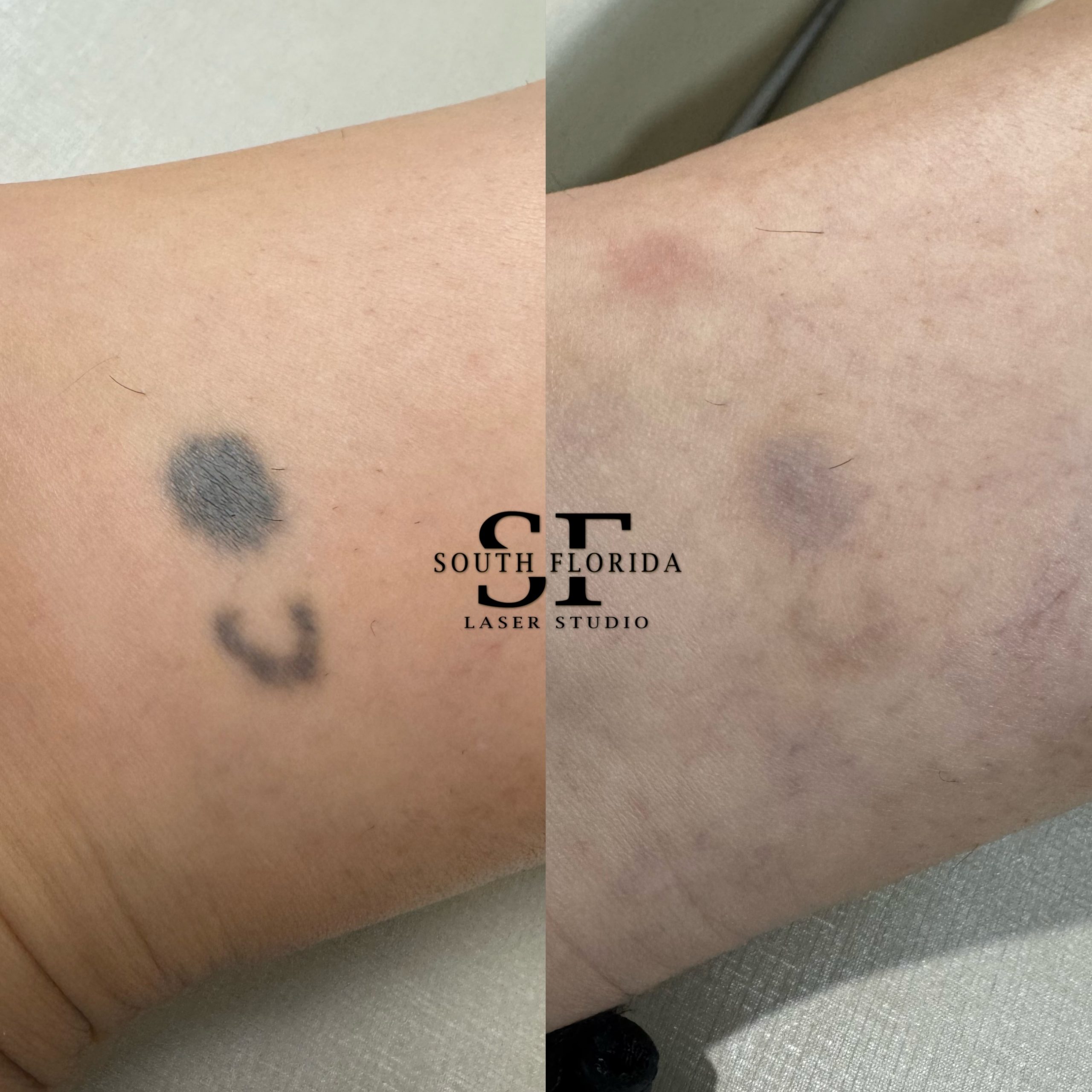 Close-up before and after laser tattoo removal results at South Florida Laser Studio