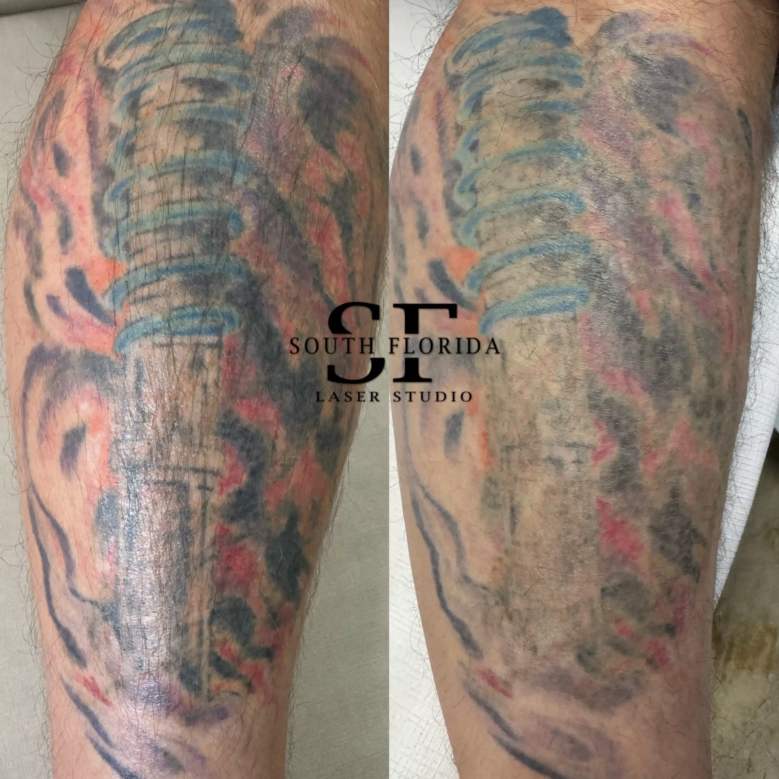 Before and after removal of large multicolor tattoo — South Florida Laser Studio