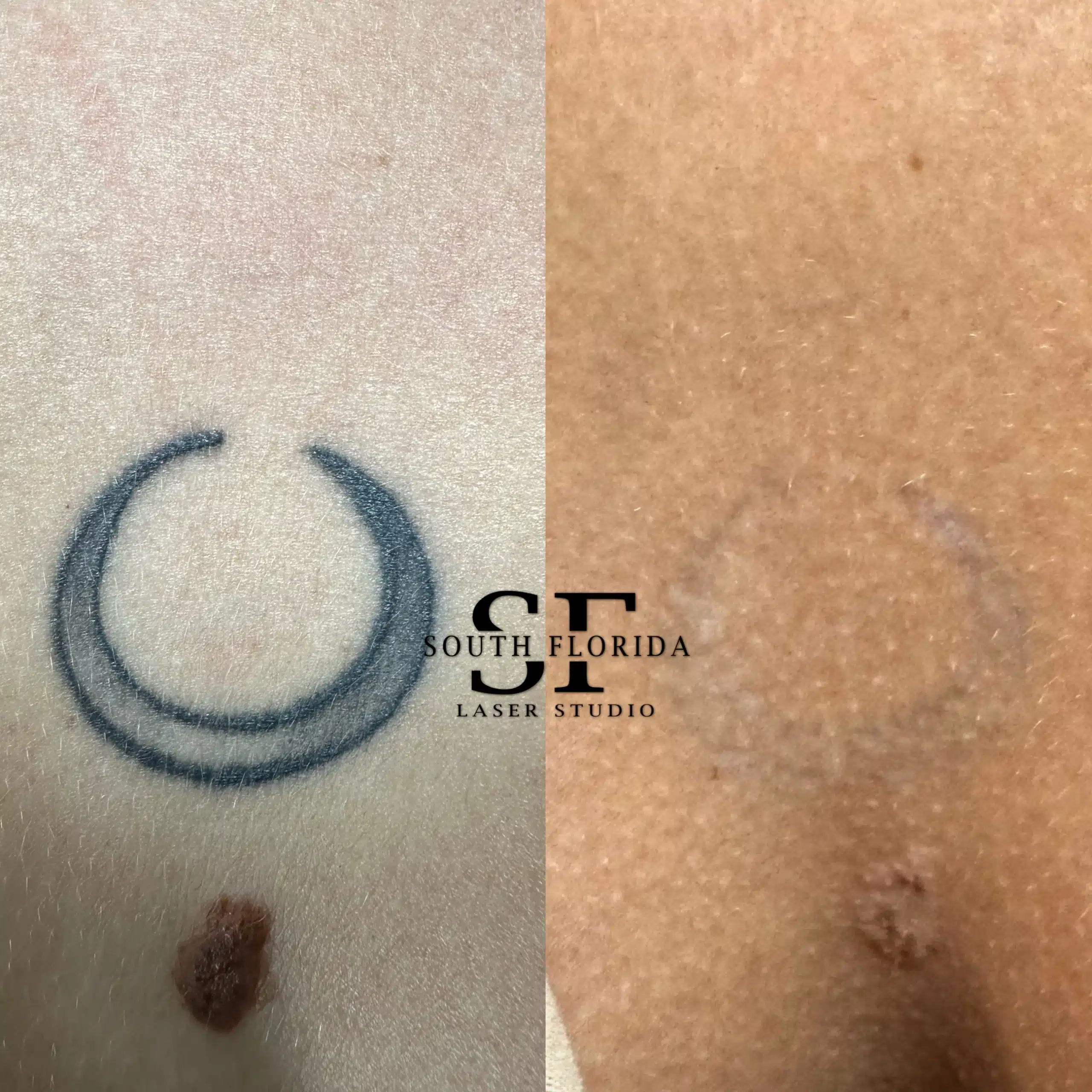 Before and after laser tattoo removal of black ink — South Florida Laser Studio Miami & Boca Raton