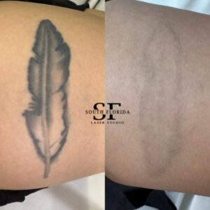 Side-by-side feather tattoo comparison with South Florida Laser Studio branding.
