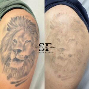 Side-by-side lion tattoo comparison on an upper arm with South Florida Laser Studio branding.